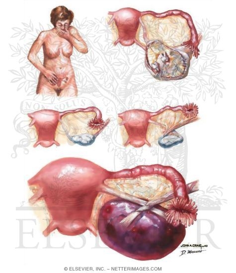 Ovarian Torsion