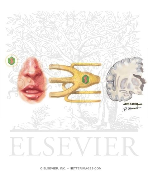 HSV - Encephalitis