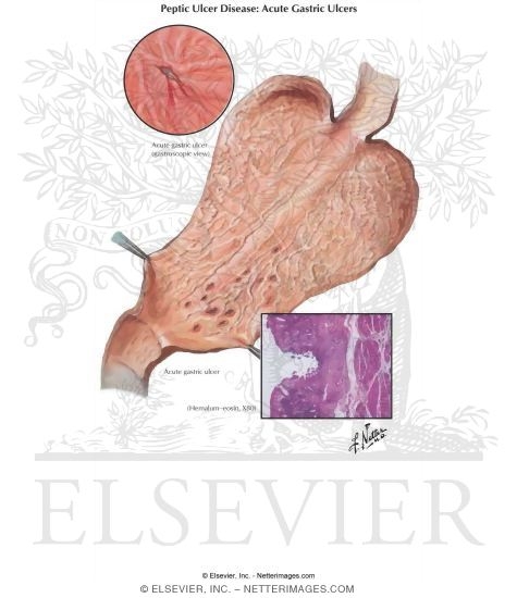 Peptic Ulcer I - Acute Gastric Ulcer