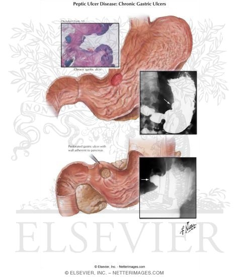 Peptic Ulcer III - Chronic Gastric Ulcer