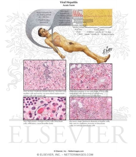 Viral Hepatitis: Acute Form