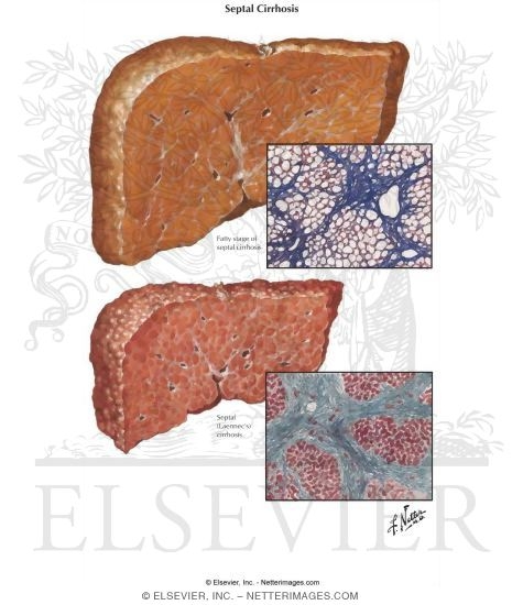 Septal Cirrhosis