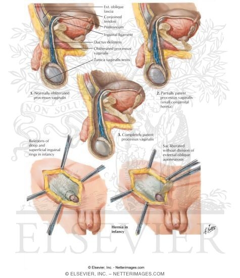 Hernia I - Indirect and Direct Inguinal Hernias