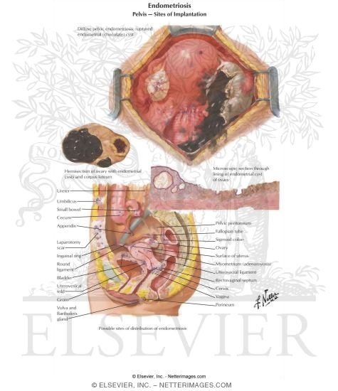 Possible Locations of Endometrial Implants