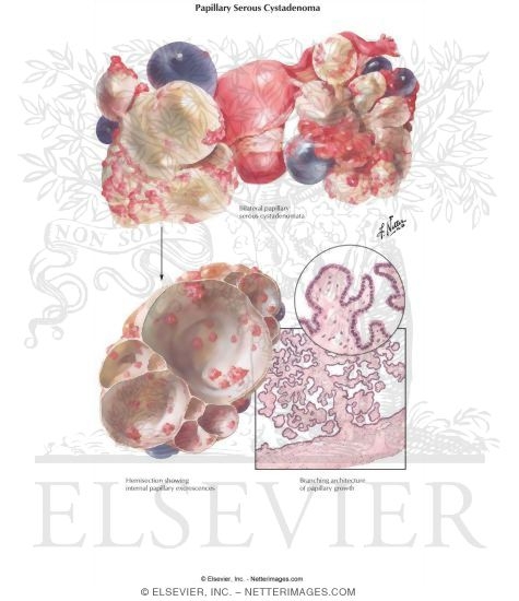 Papillary Serous Cystadenoma