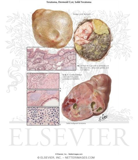 Teratoma, Dermoid Cyst, Solid Teratoma
