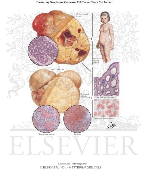 Feminizing Neoplasms, Granulosa Cell Tumor, Theca Cell Tumor