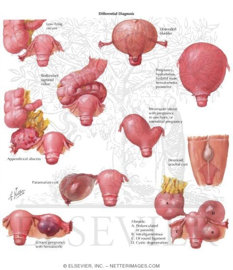 Conditions Simulating Ovarian Neoplasms-Differential Diagnosis