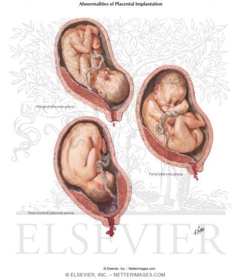 Abnormalities of Placental Implantation