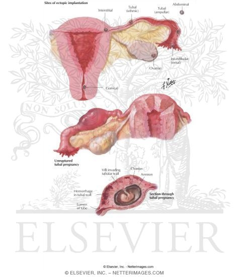 Ectopic Pregnancy I - Tubal Pregnancy