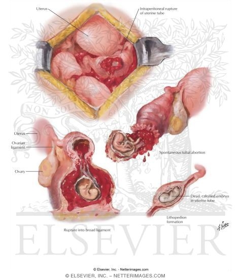 Tubal Pregnancy