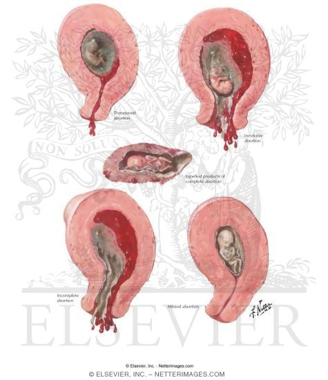 Abortion
