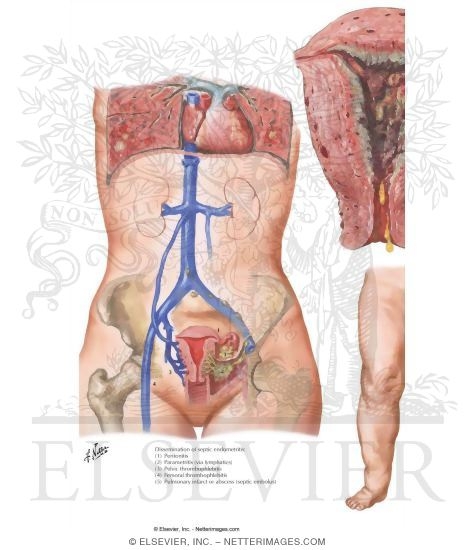 Puerperal Infection