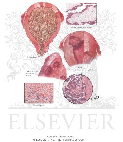 Gestational Trophoblastic Disease The preview images do not contain enough 