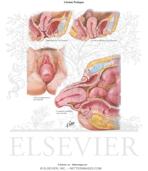 Uterine Prolapse