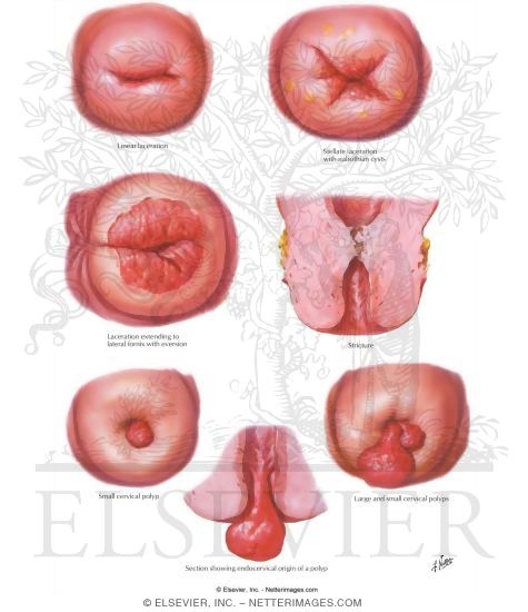 Lacerations, Strictures, Polyps