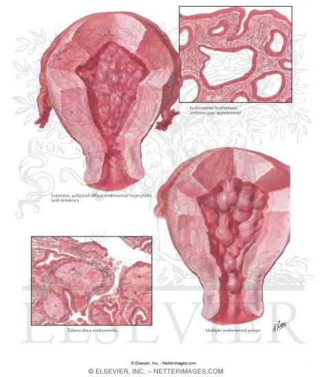 Endometrial Hyperplasia and Polyps, Tuberculous Endometritis