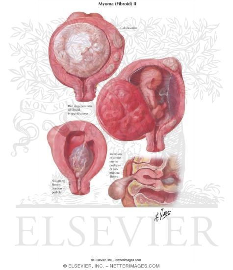 Myoma (Fibroid) II - Secondary Changes