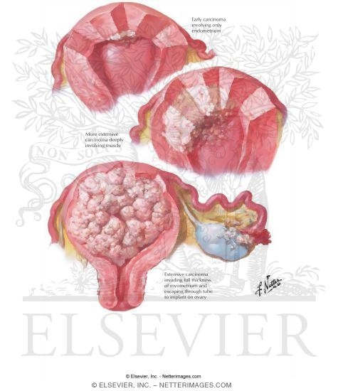 Endometrial Cancer