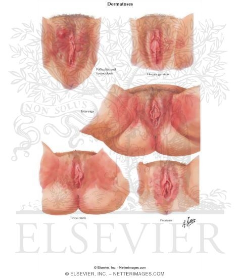 Dermatoses