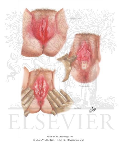 Vulvitis I - Diabetes, Trichomoniasis, Moniliasis