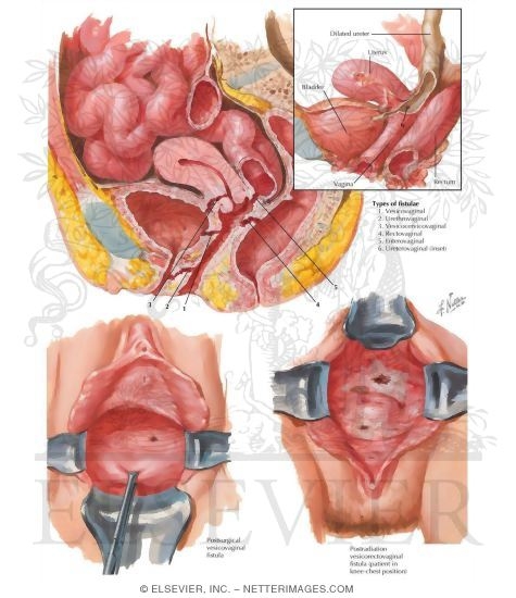 Fistulae: Gastrointestinal and Urinary Tract