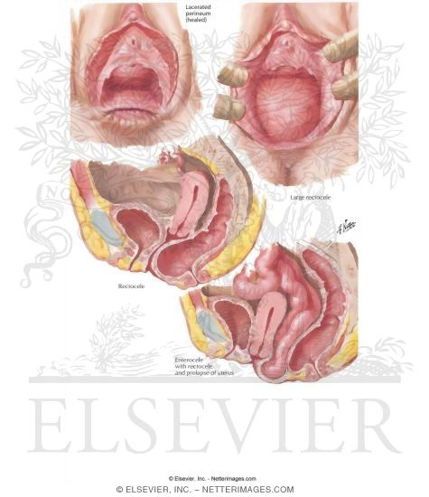 Rectocele, Enterocele