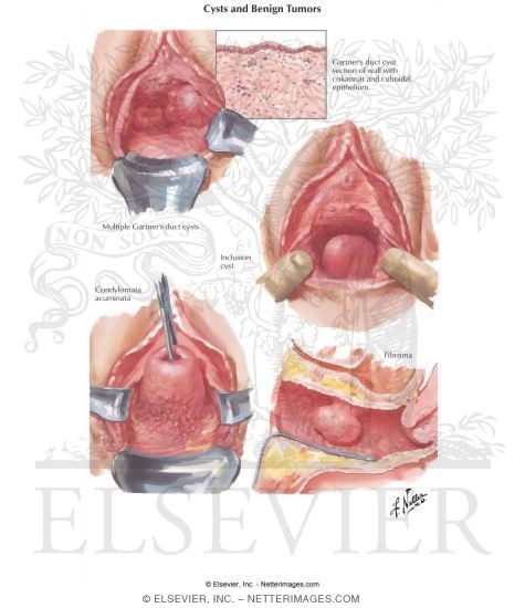 Cysts and Benign Tumors