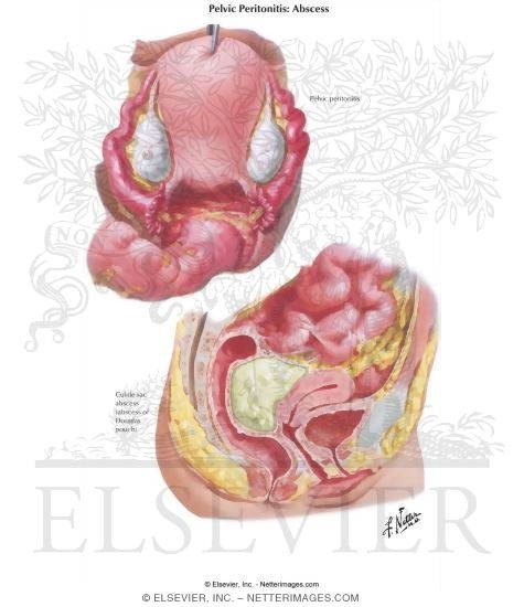 Pelvic Peritonitis, Abscess