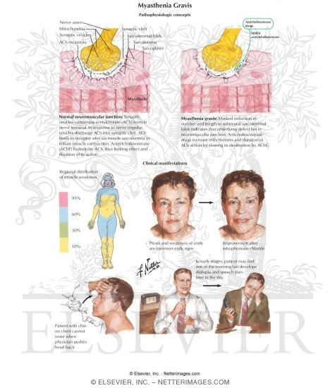 myasthenia gravis images. Myasthenia Gravis