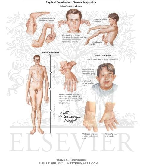 Physical Examination: General Inspection - Ehlers-Danlos Syndrome
