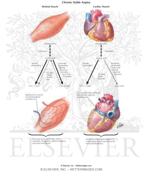 Chronic Stable Angina