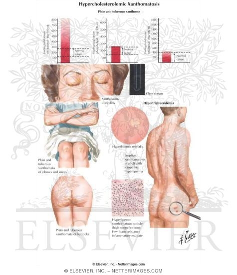 Hypercholesterolemic Xanthomatosis