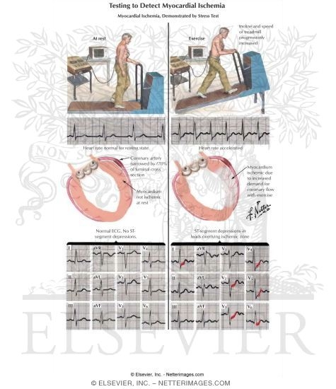 Testing to Detect Myocardial Ischemia