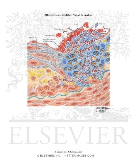 Atherogenesis: Unstable Plaque Formation