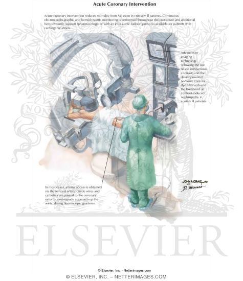 Acute Coronary Intervention