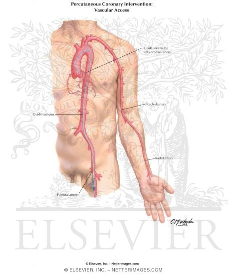 Percutaneous Coronary Intervention: Vascular Access