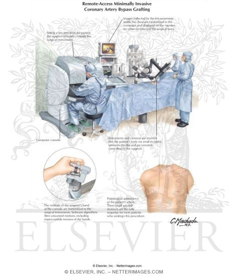 Remote-Access Minimally Invasive Coronary Artery Bypass Grafting
