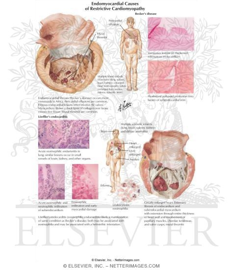 Endomyocardial Causes of Restrictive Cardiomyopathy