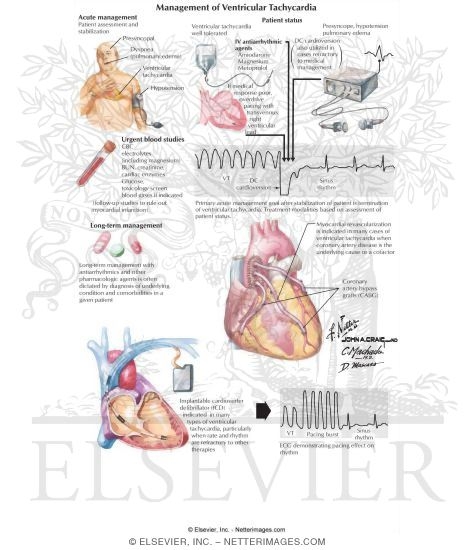 Management of Ventricular Tachycardia