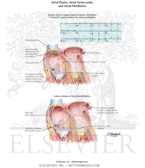 Atrial Flutter, Atrial Tachycardia, and Atrial Fibrillation
