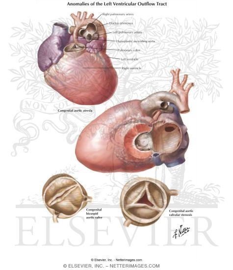 Anomalies of the Left Ventricular-Outflow Tract