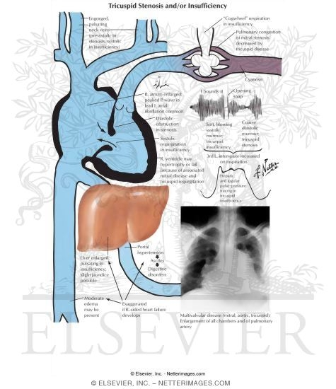 Tricuspid Stenosis And/or Insufficinecy