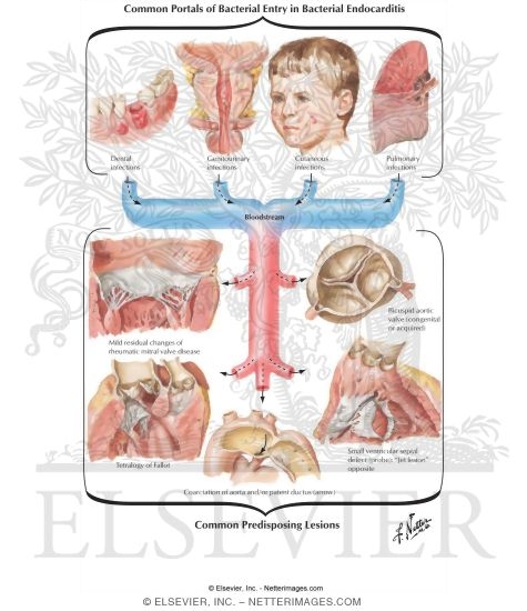 Common Portals of Bacterial Entry in Bacterial Endocarditis