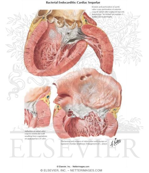 Cardiac Sequelae