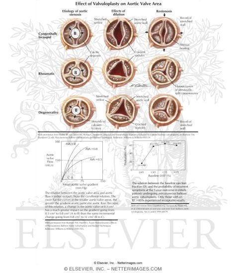 Aortic Valvuloplasty