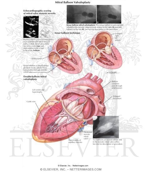 Mitral Balloon Valvuloplasty
