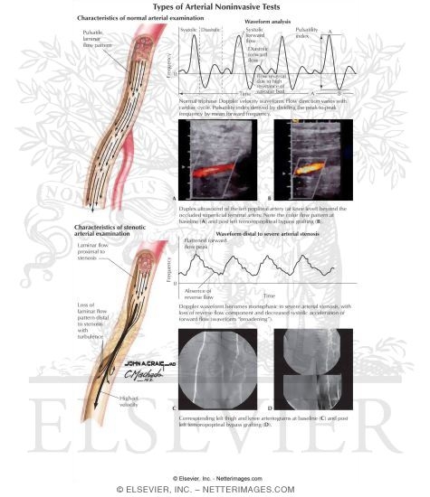 Types of Arterial Noninvasive Tests