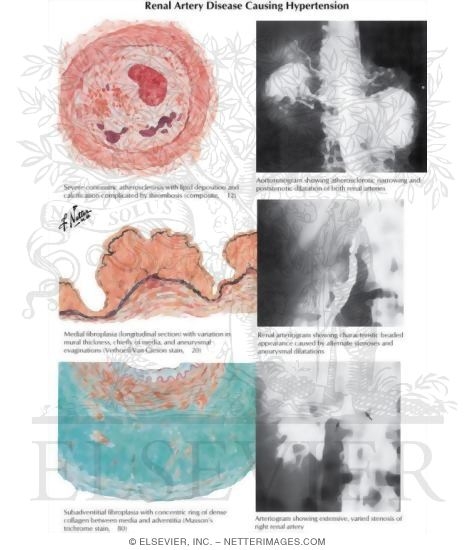 Renal Artery Disease Causing Hypertension