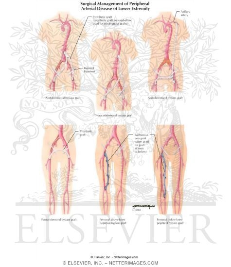 peripheral vascular disease peripheral vascular disease